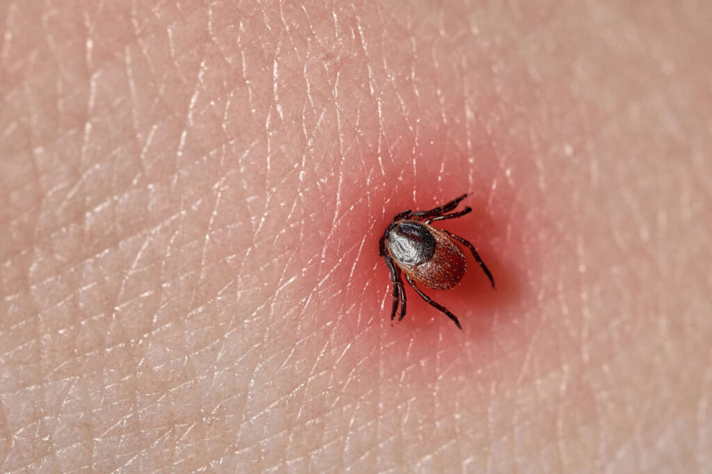 garrapata adherida al cuerpo enfermedad de lyme